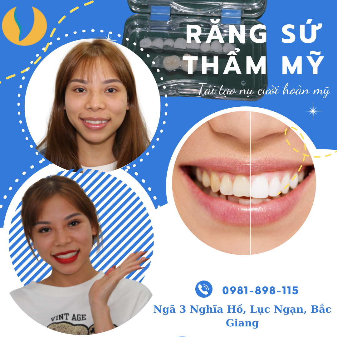 Răng sứ thẩm mỹ